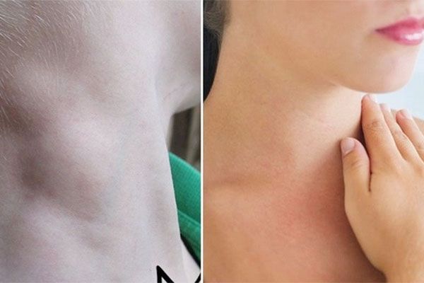 Bệnh nhân ung thư hạch ở giai đoạn cuối hạch bạch huyết thường sưng to