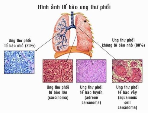 Các loại ung thư phổi