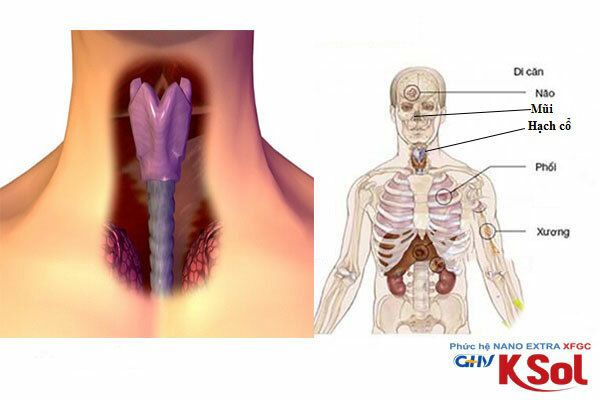 Nhưng cơ quan ung thư vòm họng di căn trên cơ thể