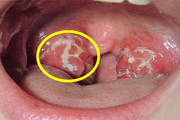Ung thư vòm họng xuất phát từ vòm họng phía sau hốc mũi