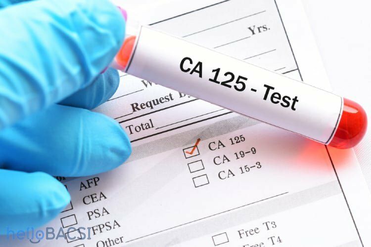 Xét nghiệm CA 125 chẩn đoán dấu ấn ung thư buồng trứng sớm