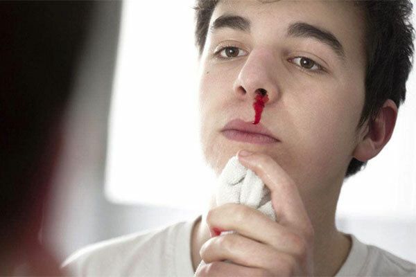 Thường xuyên chảy máu cam có thể triệu chứng ung thư vòm họng giai đoạn 2
