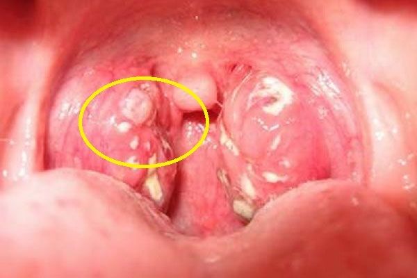 Dấu hiệu nhận biết ung thư vòm họng giai đoạn đầu