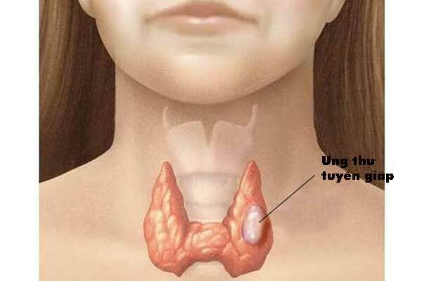 Độ tuổi mắc bệnh ung thư tuyến giáp chủ yếu từ 40 - 60