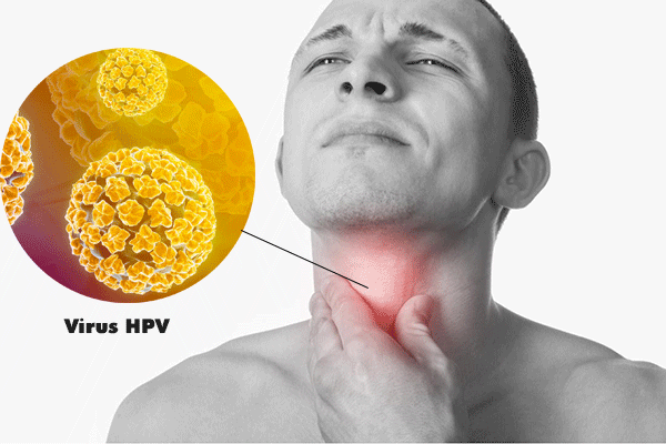 Virus HPV là một trong những nguyên nhân gây ung thư vòm họng