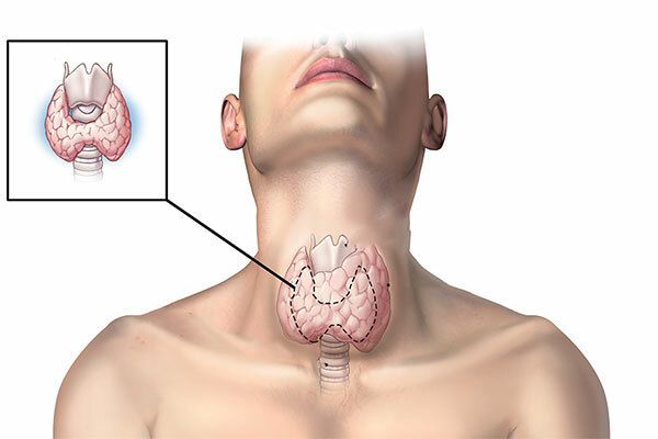 Ung thư tuyến giáp - căn bệnh được chữa khỏi nêu như phát hiện sớm