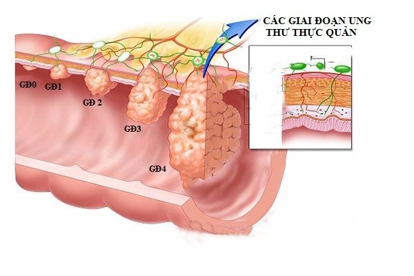 Các giai đoạn ung thư phát triển ung thư thực quản