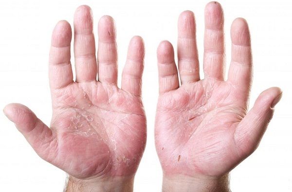 Dấu hiệu bàn tay son khi ung thư buồng trứng di căn gan