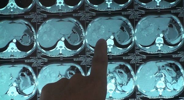 Hình ảnh chụp MRI mang đến kết quả ung thư gan tương đối chính xác
