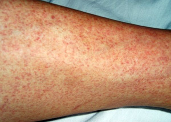 Xuất huyết dưới da cảnh báo ung thư gan