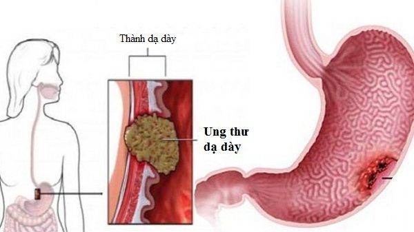 Các triệu chứng ung thư dạ dày giai đoạn đầu – Hướng dẫn nhận biết và phát  hiện sớm