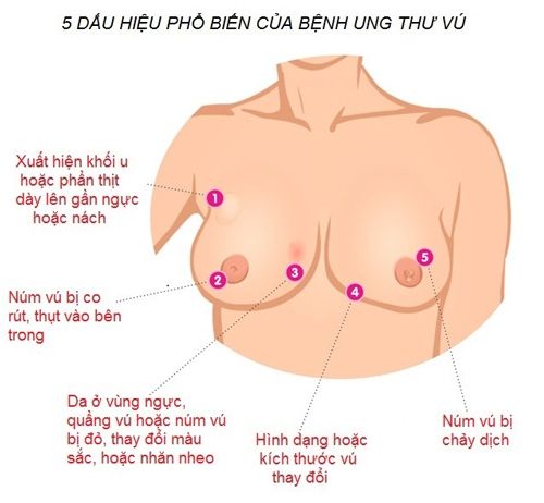 Núm vú có sự thay đổi bất thường là một trong những dấu hiệu bệnh ung thư vú chị em cần lưu ý.