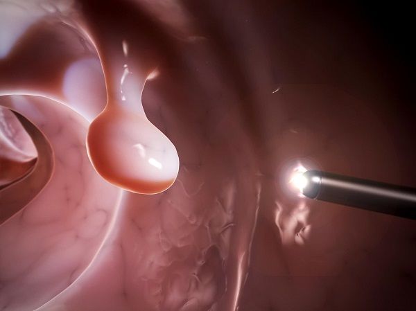 Phát hiện polyp đại tràng sớm giúp ngăn ngừa tiến triển thành ung thư đại tràng