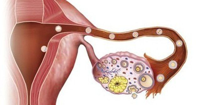 Ung thư buồng trứng là căn bệnh xuất hiện tế bào ung thư ác tính ở một hoặc cả 2 bên buồng trứng