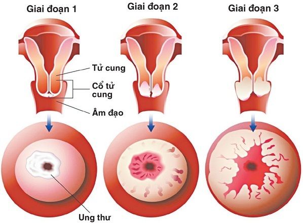 Tỷ lệ sống của người mắc ung thư cổ tử cung phụ thuộc nhiều vào giai đoạn phát hiện bệnh