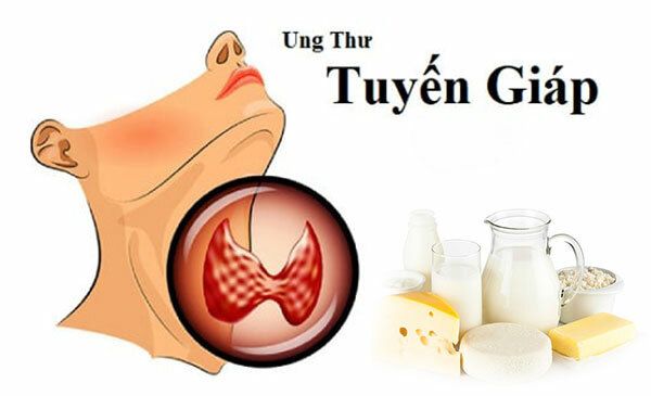 Người bệnh ung thư tuyến giáp nên hạn chế sử dụng các loại thực phẩm từ sữa