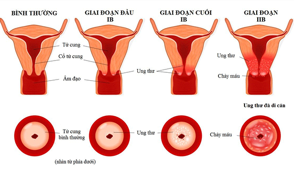 Các giai đoạn ung thư cổ tử cung