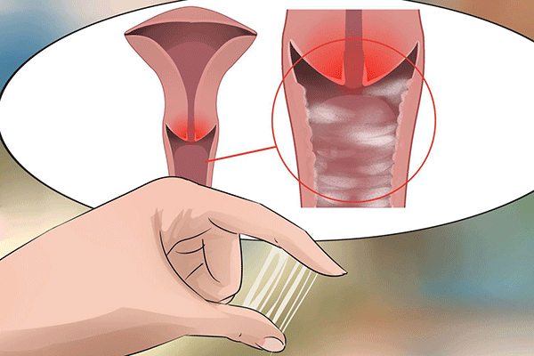 Dịch âm đạo tiết ra nhiều là một trong những biểu hiện của bệnh ung thư cổ tử cung giai đoạn đầu