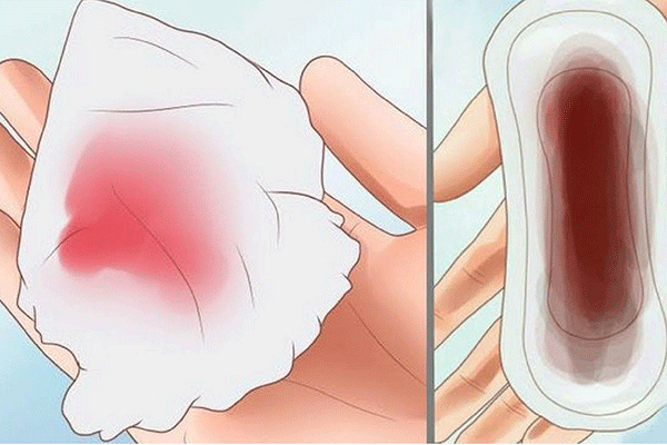 dấu hiệu ung thư buồng trứng