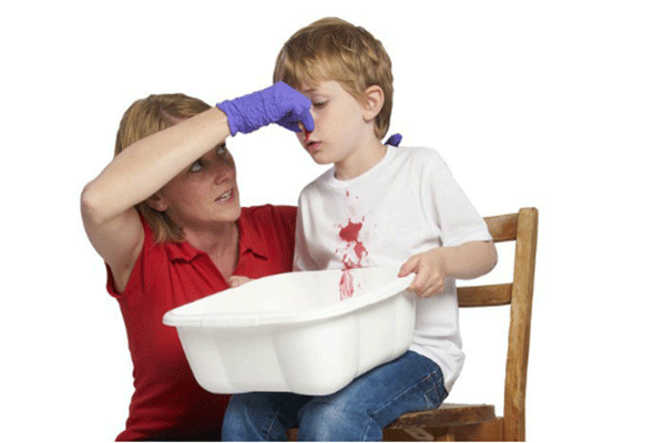 Chảu máu cam là một trong những biểu hiện của bệnh ung thư máu ở trẻ em cần được nhận biết sớm