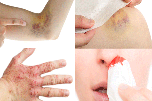 Da xuất hiện các vết bầm tím, chảy máu cam là những triệu chứng cảnh báo mắc ung thư máu không nên chủ quan