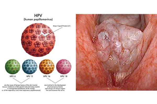 Nhiễm virus HPV là một trong những nguyên nhân gây ung thư cổ tử cung