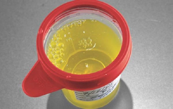 Nước tiểu có bong bóng, nổi bọt là một trong các dấu hiệu ung thư đại tràng giai đoạn cuối