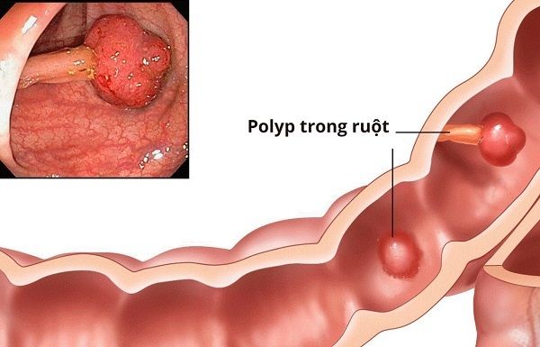 Phát hiện và loại bỏ polyp sớm để ngăn ngừa phát triển thành ung thư đại tràng