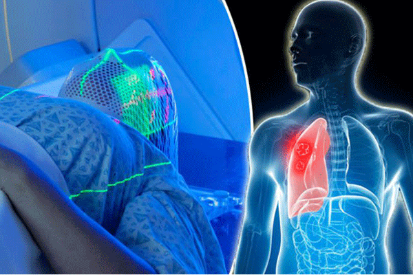 Tác dụng phụ khi xạ trị ung thư ảnh hưởng đến phổi và não trong quá trình điều trị