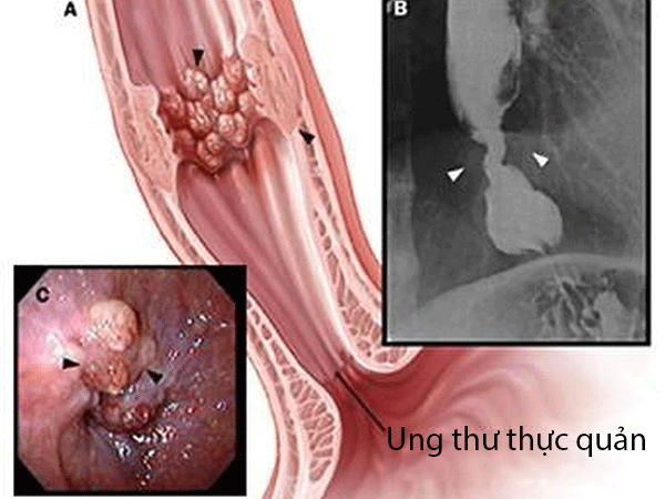 7 triệu chứng ung thư thực quản bạn chớ nên bỏ qua!