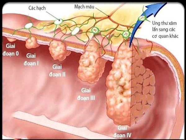 Việc phát hiện ung thư đại tràng giai đoạn đầu khả năng chữa khỏi đạt đến 90%