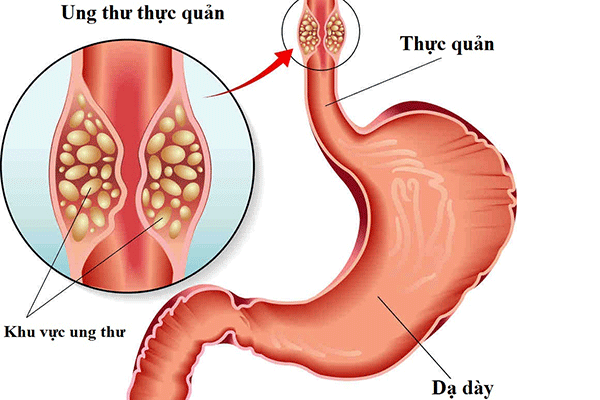 Ung thư thực quản sống được bao lâu phụ thuộc vào từng loại ung thư thực quản