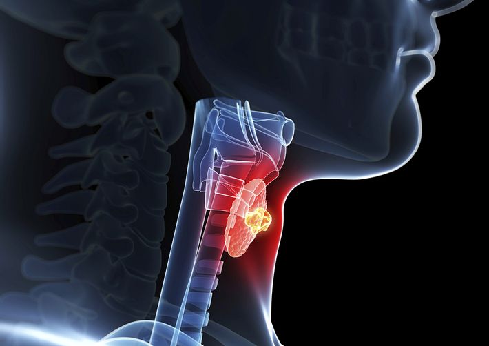 Ung thư tuyến giáp khi mới ở giai đoạn đầu thường rất khó để phát hiện ra