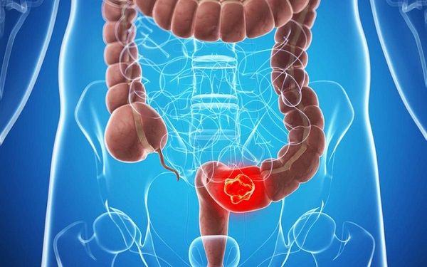 Có rất nhiều yếu tố gây ung thư dại trực tràng