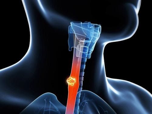 Hóa trị có thể sử dụng trước khi phẫu thuật hoặc kết hợp với xạ trị nhằm tăng hiệu quả điều trị ung thư thực quản