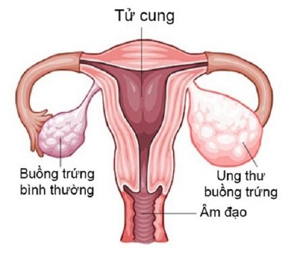 Ung thư buồng trứng xuất phát từ sự tăng trưởng bất thường của các tế bào ác tính tại buồng trứng