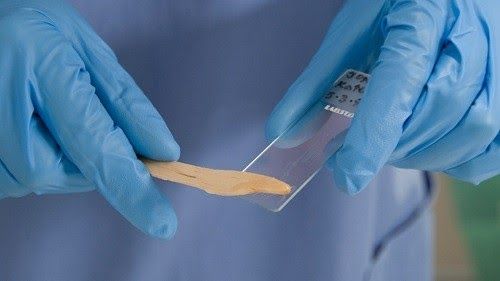 Xét nghiệm Pap phát hiện những bất thường sớm ở cổ tử cung