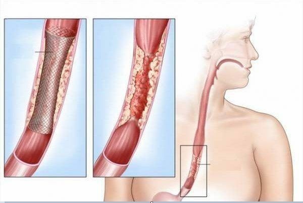 Ung thư thực quản là một căn bệnh rất nguy hiểm