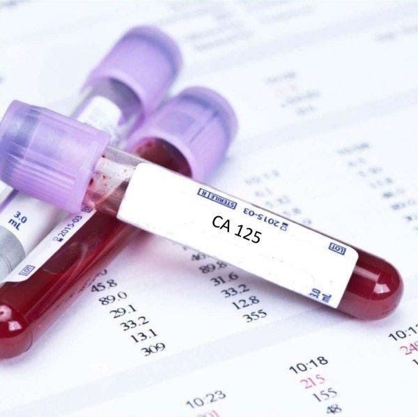 Xét nghiệm CA 125 chẩn đoán dấu ấn ung thư buồng trứng sớm