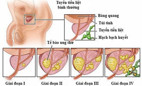 Ung thư tuyến tiền liệt giai đoạn cuối có biểu hiện phức tạp và tiên lượng xấu