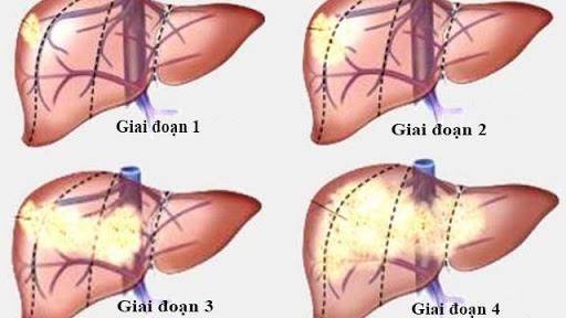 Hình ảnh các giai đoạn của ung thư gan