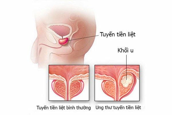 Ung thư tuyến tiền liệt phổ biến hơn ở nam giới lớn tuổi