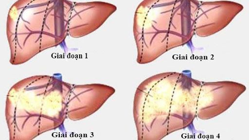 Ở giai đoạn 4 các khối u ở vùng thùy, hay những khối u xâm lấn vào các nhánh chính của tĩnh mạch gan và các bộ phận khác trên cơ thể