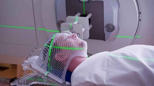 Xạ trị là một trong những cách điều trị ung thư vòm họng