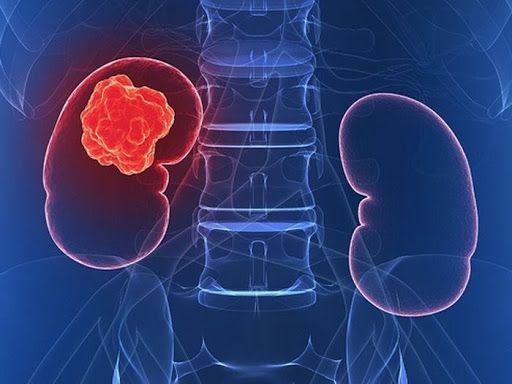 Ung thư thận là một bệnh ung thư khởi phát từ các tế bào trong thận
