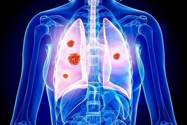 Xạ trị ung thư phổi giúp ngăn ngừa ung thư tái phát