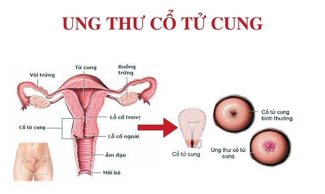 Ung thư cổ tử cung là bệnh lý phổ biến của phụ nữ
