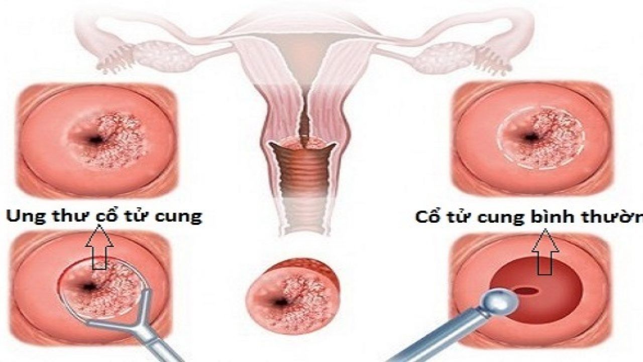 Ung thư cổ tử cung bắt đầu từ sự phát triển bất thường ở cổ tử cung, phần dưới của tử cung, lộ vào trong âm đạo
