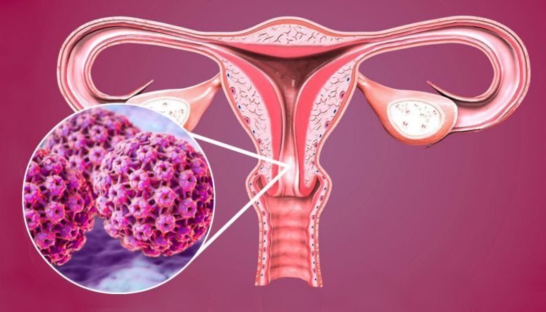 Human Papilloma Virus (HPV) - nguyên nhân chính gây ung thư cổ tử cung ở phụ nữ