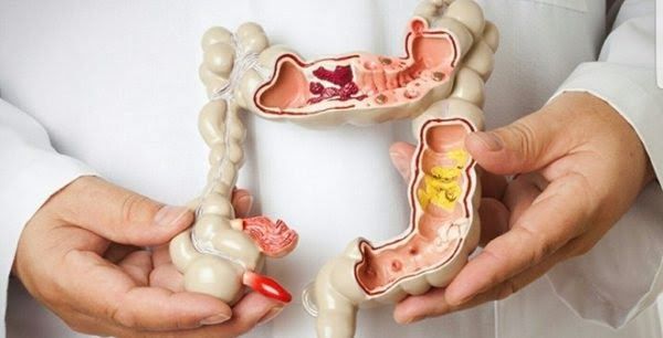Tùy vào tình trạng ung thư, người bệnh có thể phải cắt 1 phần hay toàn bộ đại tràng